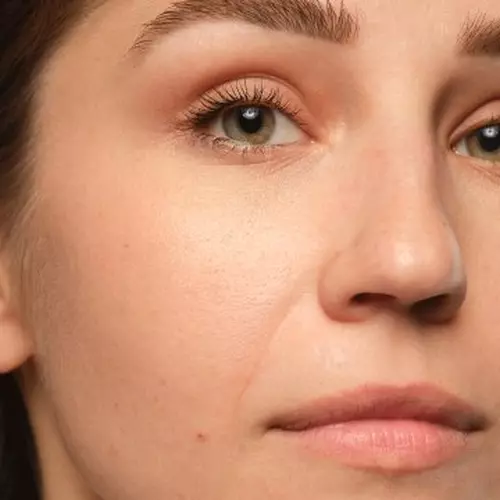 Shine skin concern